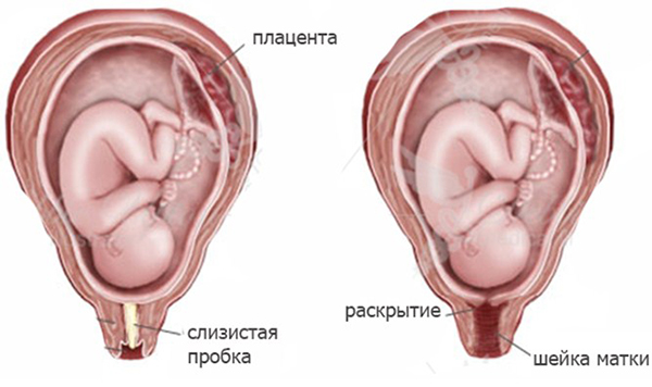 Схема защиты плода